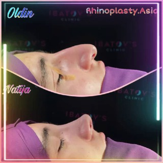 Rinoplastika.Asia_ Burun Plastikasi Markazi